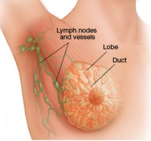Various stages of breast cancer
