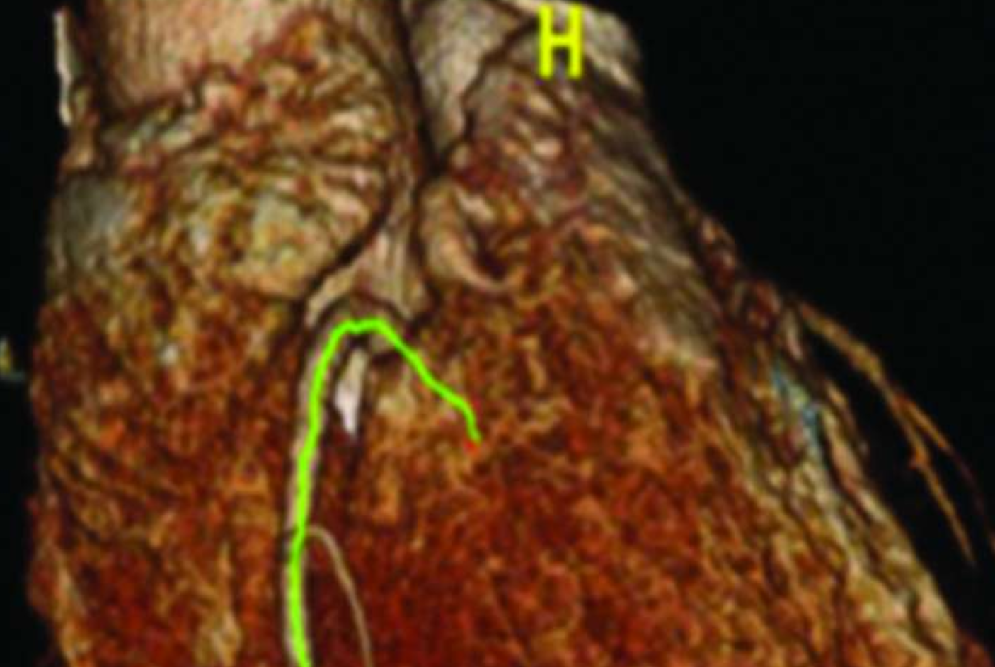 Mapping fat accumlation around coronary artery with a new non-invasive imaging technique